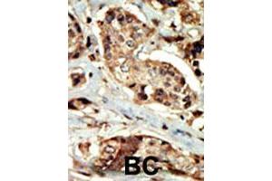 Formalin-fixed and paraffin-embedded human cancer tissue reacted with STK16 polyclonal antibody  , which was peroxidase-conjugated to the secondary antibody, followed by DAB staining. (STK16 Antikörper  (AA 257-286))