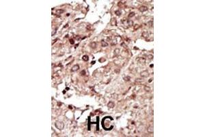 Formalin-fixed and paraffin-embedded human cancer tissue reacted with the primary antibody, which was peroxidase-conjugated to the secondary antibody, followed by AEC staining. (PHKG1 Antikörper  (AA 302-332))