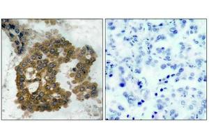 Immunohistochemical analysis of paraffin-embedded human lung carcinoma tissue using Akt2(Phospho-Ser474) Antibody(left) or the same antibody preincubated with blocking peptide(right). (AKT2 Antikörper  (pSer474))