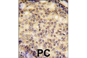 Formalin-fixed and paraffin-embedded human prostate carcinoma tissue reacted with SOX9 polyclonal antibody  , which was peroxidase-conjugated to the secondary antibody, followed by DAB staining. (SOX9 Antikörper  (N-Term))