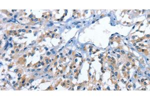 Immunohistochemistry of paraffin-embedded Human thyroid cancer tissue using PAK6 Polyclonal Antibody at dilution 1:40 (PAK6 Antikörper)