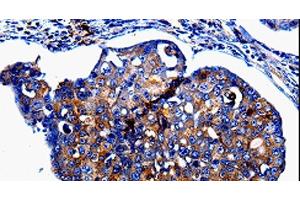 Immunohistochemistry of paraffin-embedded Human breast cancer tissue using IL10RB Polyclonal Antibody at dilution 1:60 (IL10RB Antikörper)