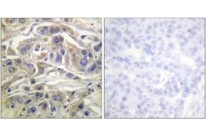 Immunohistochemistry analysis of paraffin-embedded human breast carcinoma, using RapGEF1 (Ab-504) Antibody. (GRF2 Antikörper  (AA 470-519))