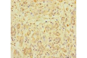 Immunohistochemistry of paraffin-embedded human pancreatic cancer using ABIN7176219 at dilution of 1:100 (ZNF287 Antikörper  (AA 130-364))