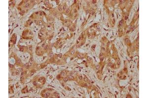 IHC image of ABIN7155266 diluted at 1:300 and staining in paraffin-embedded human melanoma cancer performed on a Leica BondTM system. (KAT2A Antikörper  (AA 302-537))