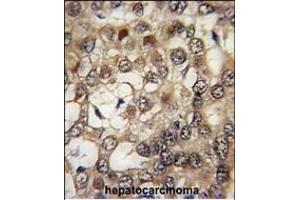 Formalin-fixed and paraffin-embedded human hepatocarcinoma tissue reacted with HIPK2 Antibody (Center) (ABIN391777 and ABIN2841636) , which was peroxidase-conjugated to the secondary antibody, followed by DAB staining. (HIPK2 Antikörper  (AA 437-468))