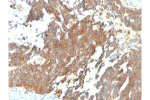 Immunohistochemical staining (Formalin-fixed paraffin-embedded sections) of human ovarian carcinoma with GNRHR/LHCGR monoclonal antibody, clone GNRHR/768 . (GNRHR Antikörper)
