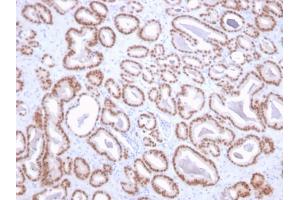 Formalin-fixed, paraffin-embedded human prostate stained with NKX3. (NKX3-1 Antikörper  (AA 92-224))