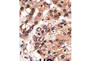 Formalin-fixed and paraffin-embedded human cancer tissue reacted with the primary antibody, which was peroxidase-conjugated to the secondary antibody, followed by AEC staining. (AF9 Antikörper  (C-Term))