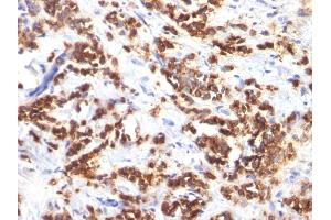 Formalin-fixed, paraffin-embedded human Breast Carcinoma stained with Milk Fat Globule Monoclonal Antibody (MFG-06) (MFGE8 Antikörper)