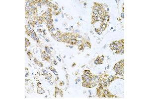 Immunohistochemistry of paraffin-embedded human gastric cancer using ALKBH8 antibody at dilution of 1:100 (x40 lens). (ALKBH8 Antikörper)