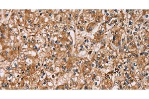 Immunohistochemistry of paraffin-embedded Human prostate cancer using HTR3C Polyclonal Antibody at dilution of 1:30 (HTR3C Antikörper)