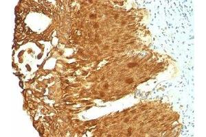 Formalin-fixed, paraffin-embedded human cervical carcinoma stained with Cytokeratin 19 antibody (KRT19/799 + KRT19/800) (Cytokeratin 19 Antikörper)