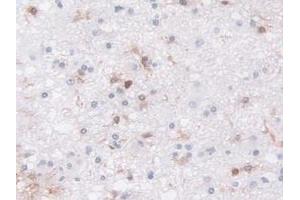 Detection of LCP1 in Human Glioma Tissue using Polyclonal Antibody to L-Plastin (LCP1) (LCP1 Antikörper  (AA 5-233))