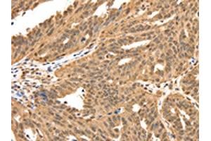 The image on the left is immunohistochemistry of paraffin-embedded Human ovarian cancer tissue using ABIN7192626(SPATA20 Antibody) at dilution 1/70, on the right is treated with synthetic peptide. (SPATA2 Antikörper)