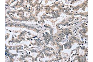 The image on the left is immunohistochemistry of paraffin-embedded Human liver cancer tissue using ABIN7192048(PTGER1 Antibody) at dilution 1/30, on the right is treated with synthetic peptide. (PTGER1 Antikörper)