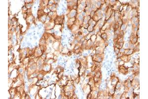 Formalin-fixed, paraffin-embedded human Renal Cell Carcinoma stained with CD10 Mouse Monoclonal Antibody (MME/2579). (MME Antikörper  (AA 583-740))