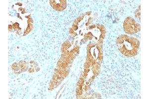 Formalin-fixed, paraffin-embedded human Rectum stained with Villin Mouse Monoclonal Antibody (VIL1/1325). (Villin 1 Antikörper  (AA 179-311))