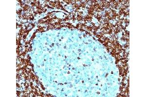 IHC testing of human non-Hodgkin's lymphoma stained with Bcl-2 antibody (124). (Bcl-2 Antikörper  (AA 41-54))