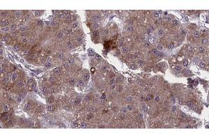 ABIN6272748 at 1/100 staining Human liver cancer tissue by IHC-P. (TAAR1 Antikörper  (Internal Region))