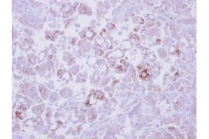 IHC-P Image Immunohistochemical analysis of paraffin-embedded human lung adenocarcinoma, using MMP13, antibody at 1:250 dilution. (MMP13 Antikörper)