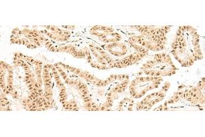 Immunohistochemistry of paraffin-embedded Human thyroid cancer tissue using BICRA Polyclonal Antibody at dilution of 1:40(x200) (BICRA Antikörper)