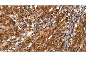 Immunohistochemistry of paraffin-embedded Human gasrtic cancer tissue using CYP2D6 Polyclonal Antibody at dilution 1:40 (CYP2D6 Antikörper)