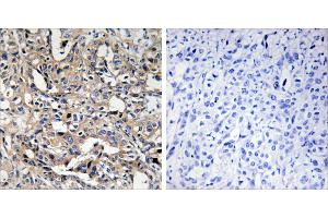 Peptide - +Immunohistochemistry analysis of paraffin-embedded human liver carcinoma tissue using BAX antibody. (BAX Antikörper)