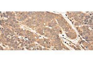 Immunohistochemistry of paraffin-embedded Human thyroid cancer tissue using ZPR1 Polyclonal Antibody at dilution of 1:40(x200) (ZNF259 Antikörper)