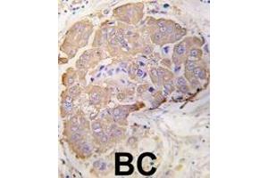 Formalin-fixed and paraffin-embedded human breast carcinoma tissue reacted with HSPB1 Antibody (S82) (ABIN391299 and ABIN2841335) , which was peroxidase-conjugated to the secondary antibody, followed by DAB staining. (HSP27 Antikörper  (AA 60-89))