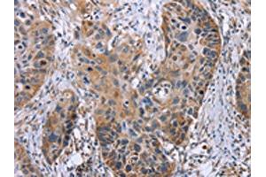 The image on the left is immunohistochemistry of paraffin-embedded Human esophagus cancer tissue using ABIN7130502(OPTN Antibody) at dilution 1/25, on the right is treated with fusion protein. (OPTN Antikörper)