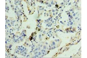Immunohistochemistry of paraffin-embedded human lung cancer using ABIN7154097 at dilution of 1:100 (GSTA4 Antikörper  (AA 93-222))
