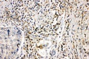 Anti-NOX1 antibody, IHC(P) IHC(P): Human Lung Cancer Tissue