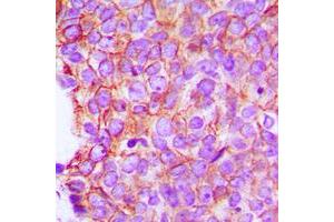 Immunohistochemical analysis of Catenin alpha 1/2 staining in human breast cancer formalin fixed paraffin embedded tissue section. (Catenin alpha 1/2 (C-Term) Antikörper)