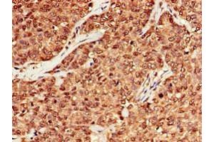 Immunohistochemistry of paraffin-embedded human ovarian cancer using ABIN7150624 at dilution of 1:100 (Mre11 Antikörper  (AA 1-205))