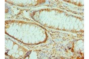 Immunohistochemistry of paraffin-embedded human colon cancer using ABIN7172290 at dilution of 1:100 (TIRAP Antikörper  (AA 1-221))