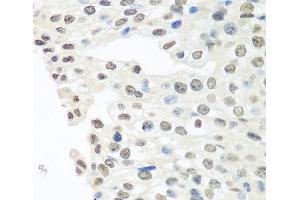 Immunohistochemistry of paraffin-embedded Human prostate cancer using TARDBP Polyclonal Antibody at dilution of 1:100 (40x lens). (TARDBP Antikörper)