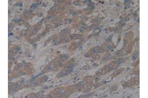 IHC-P analysis of Human Breast Cancer Tissue, with DAB staining. (CX3CL1 Antikörper  (AA 25-332))
