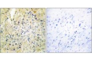 Immunohistochemistry analysis of paraffin-embedded human prostate carcinoma tissue, using DLEC1 Antibody. (DLEC1 Antikörper  (AA 1-50))