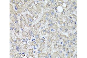 Immunohistochemistry of paraffin-embedded Human liver damage using MUC16 Polyclonal Antibody at dilution of 1:100 (40x lens). (MUC16 Antikörper)