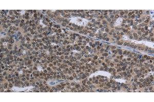 Immunohistochemistry of paraffin-embedded Human ovarian cancer tissue using MAGEC1 Polyclonal Antibody at dilution 1:30 (MAGEC1 Antikörper)