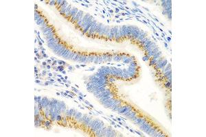 Immunohistochemistry of paraffin-embedded human colon carcinoma using UBIAD1 antibody at dilution of 1:100 (40x lens). (UBIAD1 Antikörper)