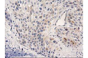 Immunohistochemical staining of paraffin-embedded Carcinoma of Human bladder tissue using anti-PLEKHA3 mouse monoclonal antibody. (PLEKHA3 Antikörper)
