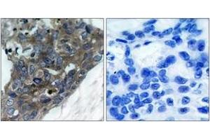 Immunohistochemistry analysis of paraffin-embedded human breast carcinoma tissue, using ASK1 (Ab-966) Antibody. (ASK1 Antikörper  (AA 932-981))