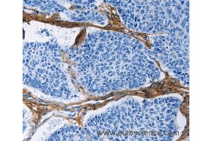 Immunohistochemistry of Human prostate cancer using COL3A1 Polyclonal Antibody at dilution of 1:60 (COL3A1 Antikörper)