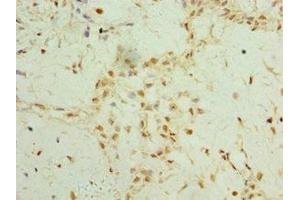 Immunohistochemistry of paraffin-embedded human breast cancer using ABIN7159637 at dilution of 1:100 (TET2 Antikörper  (AA 1833-2002))