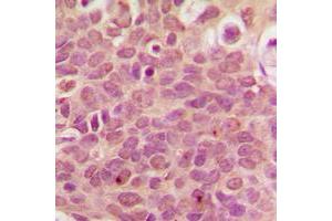 Immunohistochemical analysis of RPL36 staining in human breast cancer formalin fixed paraffin embedded tissue section. (RPL36 Antikörper  (Center))
