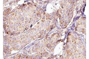 ABIN6277590 at 1/100 staining Human breast cancer tissue by IHC-P. (HSD17B10 Antikörper  (Internal Region))