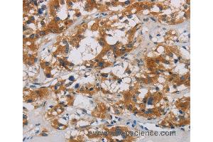 Immunohistochemistry of Human thyroid cancer using CNDP1 Polyclonal Antibody at dilution of 1:30 (CNDP1 Antikörper)