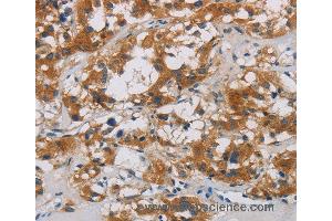 Immunohistochemistry of Human thyroid cancer using CNDP1 Polyclonal Antibody at dilution of 1:30
